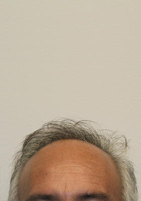 hair transplant before after Photos