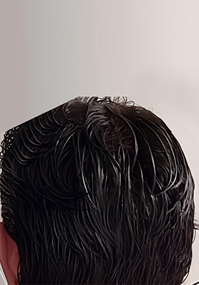 hair transplant before after Photos