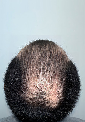 hair transplant before after Photos