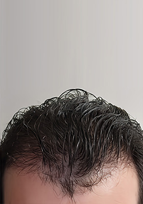 hair transplant before after Photos