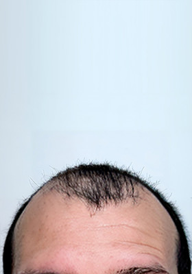 hair transplant before after Photos