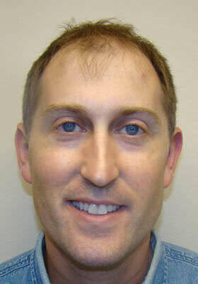 Dr Brett Bolton Patient Photos  - Mike - One Procedure