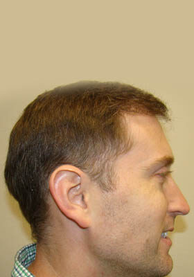 hair transplant before after Photos