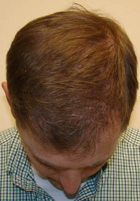 hair transplant photos