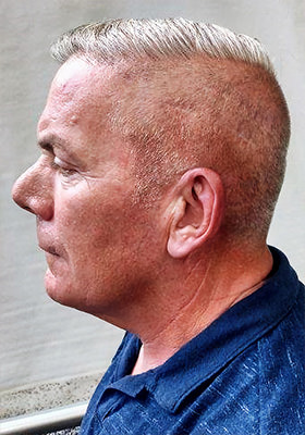 hair transplant before after Photos