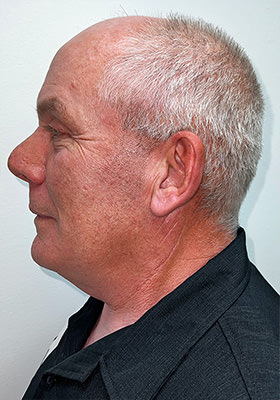 hair transplant before after Photos