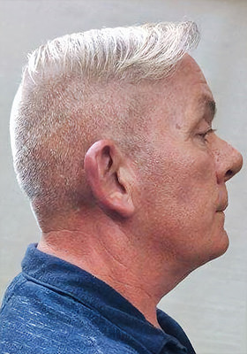 hair transplant before after Photos