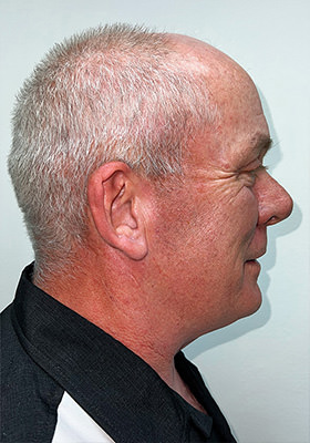 hair transplant before after Photos