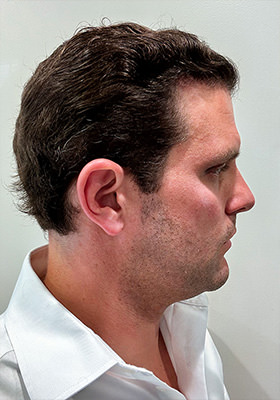 hair transplant before after Photos