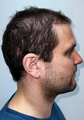 hair transplant before after Photos