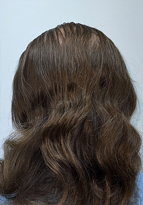 hair transplant before after Photos