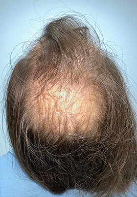 hair transplant before after Photos