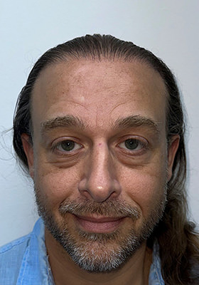 hair transplant before after Photos