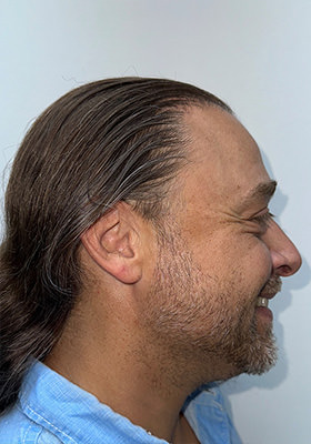 hair transplant before after Photos