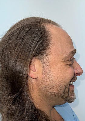 hair transplant before after Photos