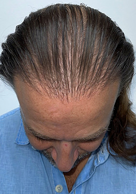hair transplant before after Photos
