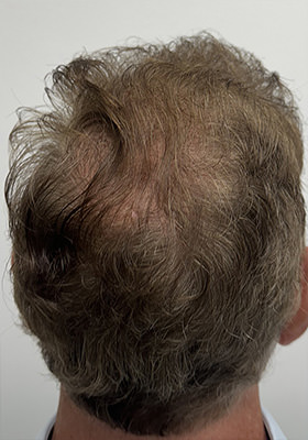 hair transplant before after Photos