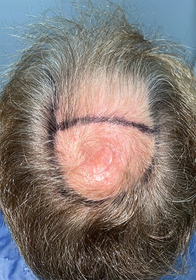 hair transplant before after Photos