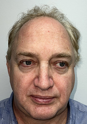 hair transplant before after Photos