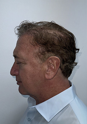 hair transplant before after Photos