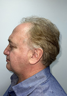 hair transplant before after Photos