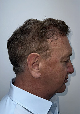 hair transplant before after Photos