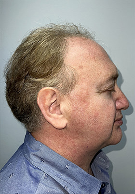 hair transplant before after Photos