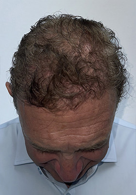 hair transplant before after Photos