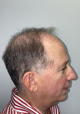 hair transplant photos