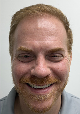 hair transplant photos
