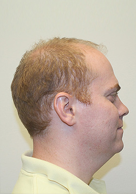 hair transplant photos
