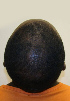 hair transplant photos