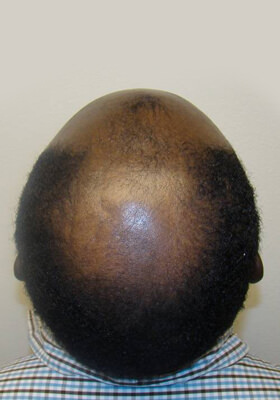 hair transplant before after Photos