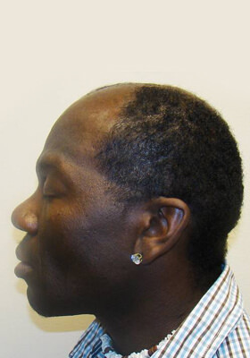 hair transplant photos