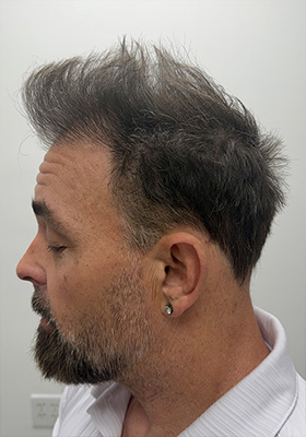 hair transplant photos