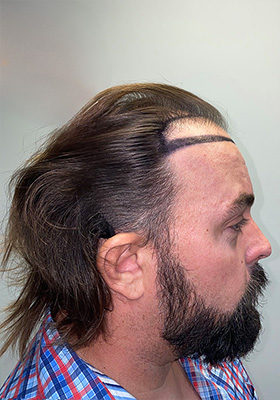 hair transplant photos