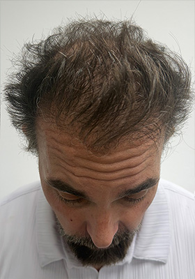 hair transplant photos
