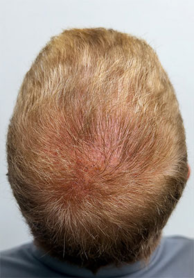hair transplant photos