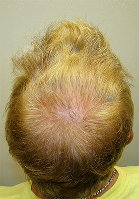 hair transplant photos