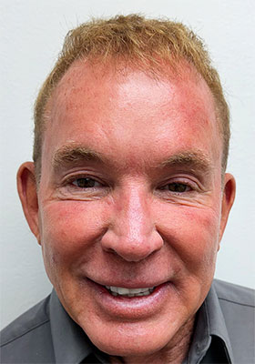 hair transplant photos