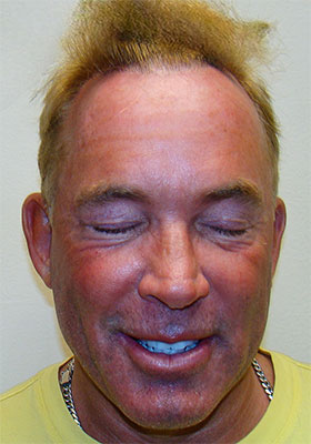 hair transplant photos
