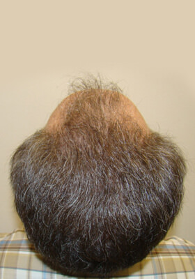 hair transplant photos