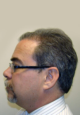 hair transplant photos