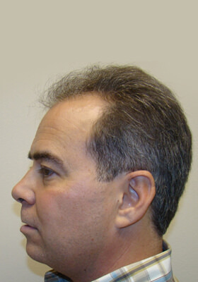 hair transplant before after Photos