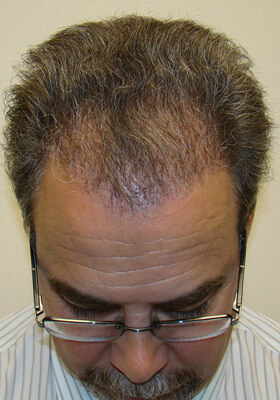 hair transplant before after Photos