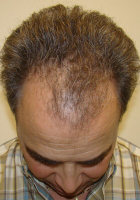 hair transplant photos