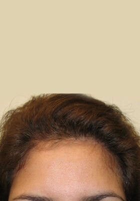 hair transplant photos