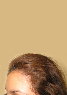 hair transplant photos