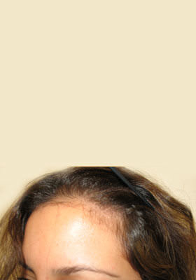 hair transplant photos