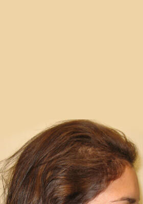 hair transplant before after Photos